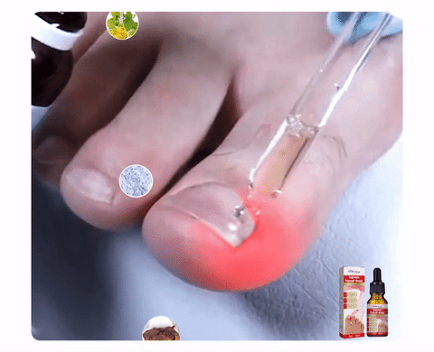 NailHelper Ingrowth Toenail Correction Treatment Oil