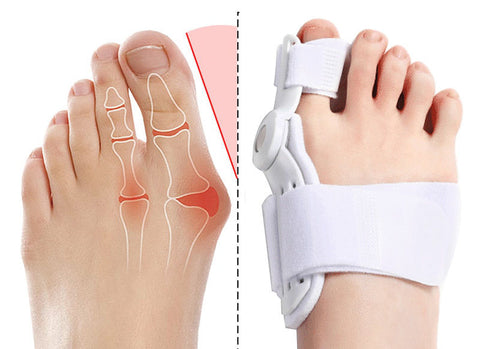 Flexible Orthopaedic Bunion Corrector (60% OFF TODAY!)