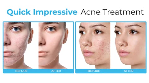 Spring Sale - Buy 2 Get 1 Free - Salicylic Acid Acne Treatment Cream